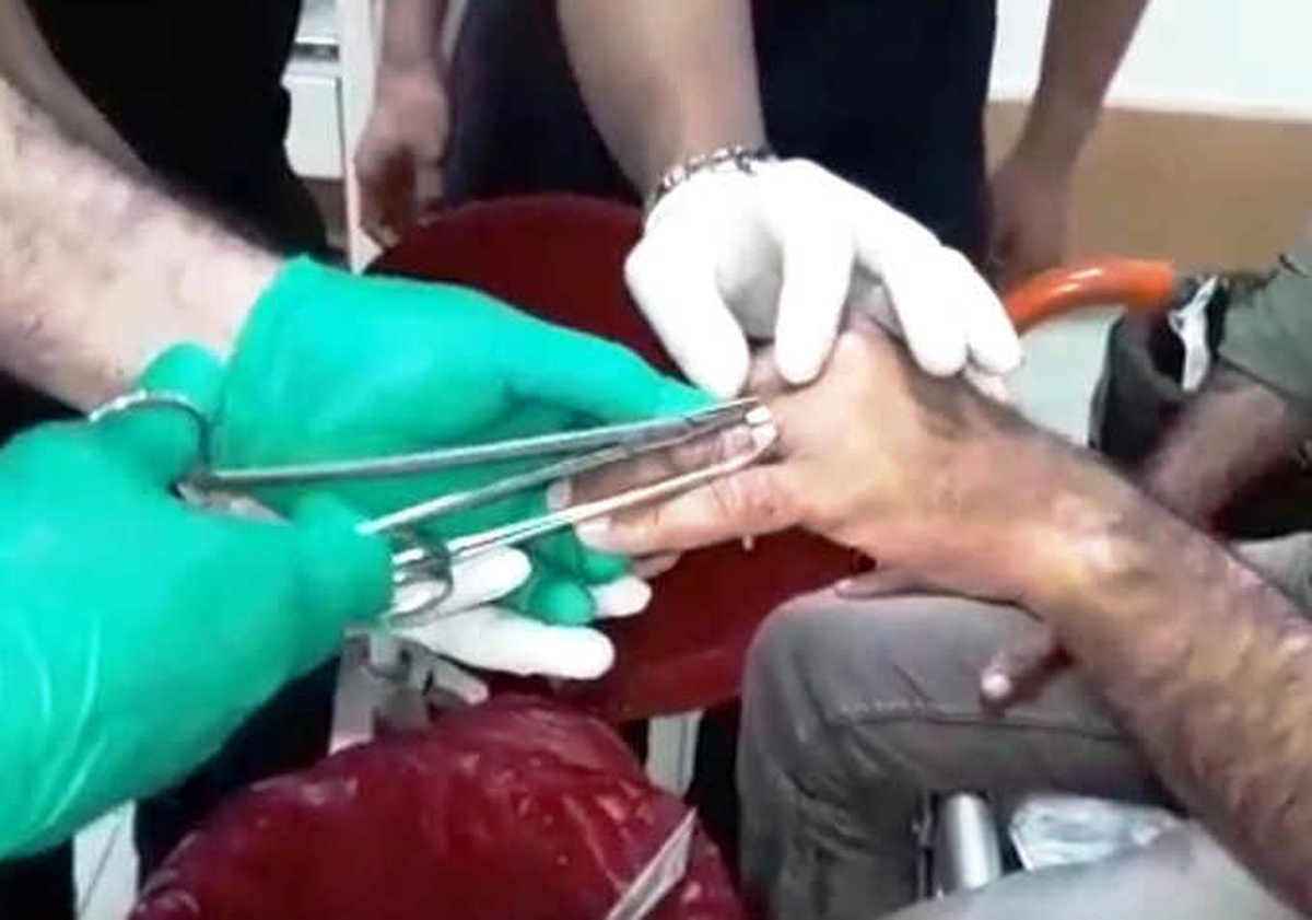 Parmağa Sıkışan Yüzük Kesilerek Çıkarıldı