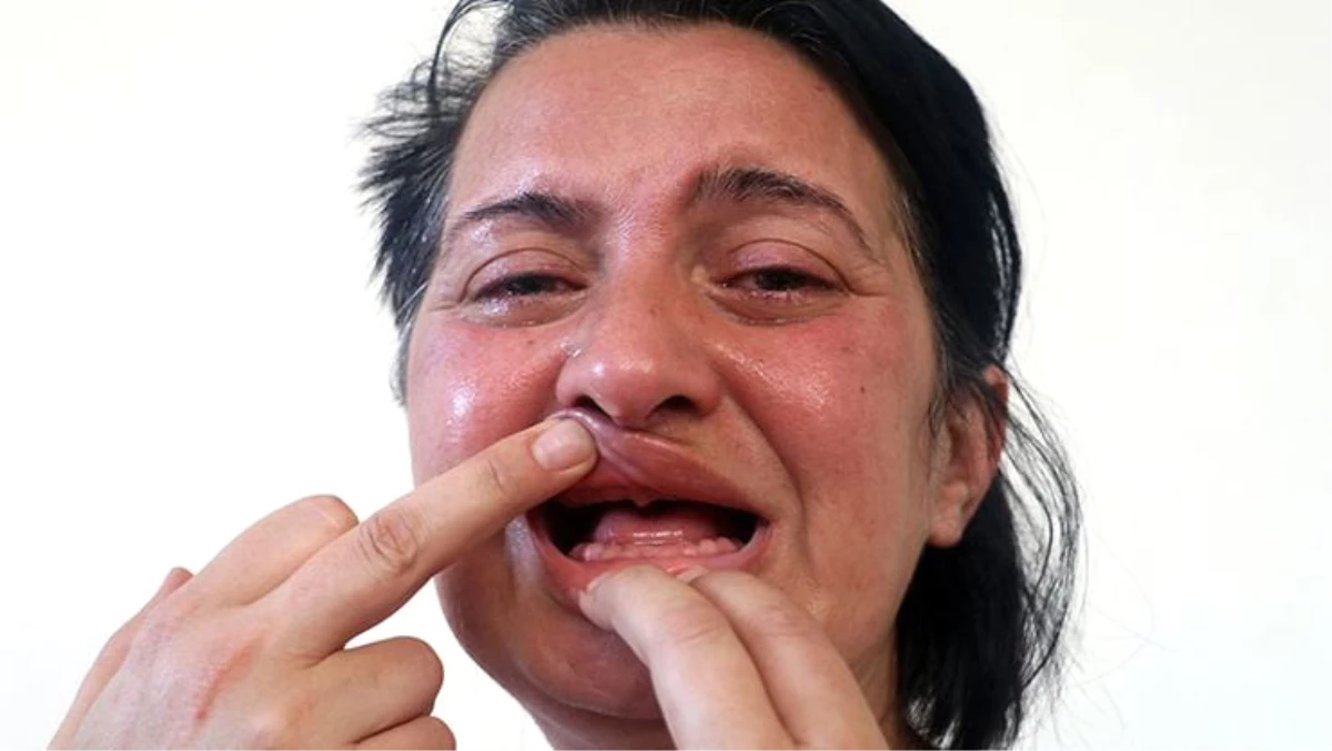 32 Dişini Kaybettiği için Acıdan Ötanazi İsteyen Kadın, Devayı Gülhane\'de Buldu