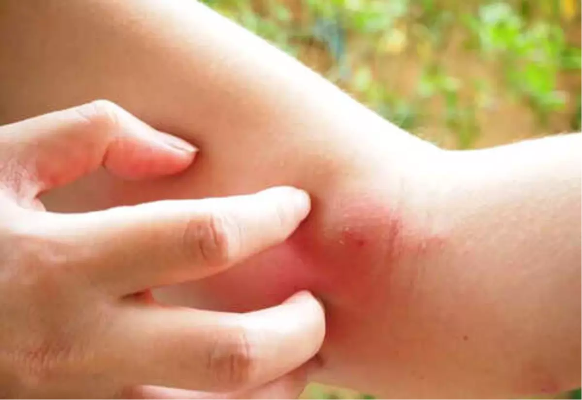 Bu Böcek Isırığına Dikkat! Felç Edebilir