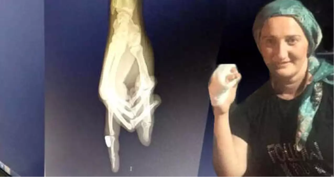 Rize\'de, Balkonda Oturan Kadının Parmağına Maganda Kurşunu İsabet Etti