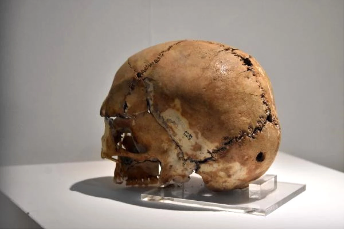 10 Bin Yıl Önce İlk Beyin Ameliyatı Yapılan Kafatasına Yoğun İlgi