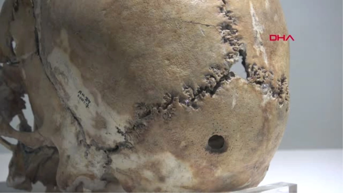 Konya On Bin Yıl Önce İlk Beyin Ameliyatı Yapılan Kafatası İlgi Görüyor Hd
