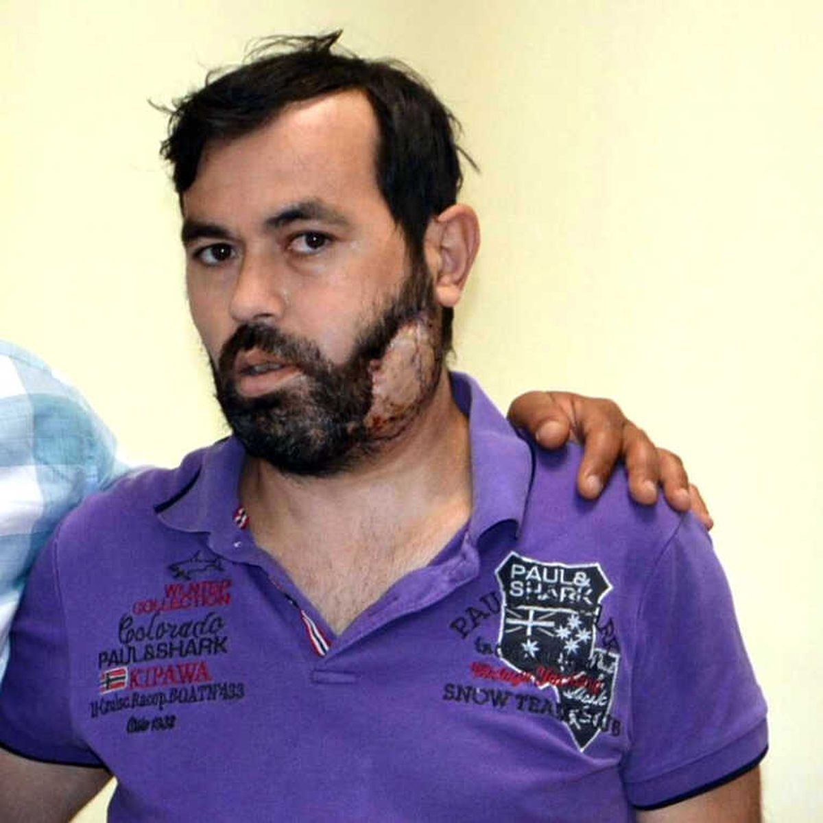 Kalça Kemiğinden Çene Yapıldı