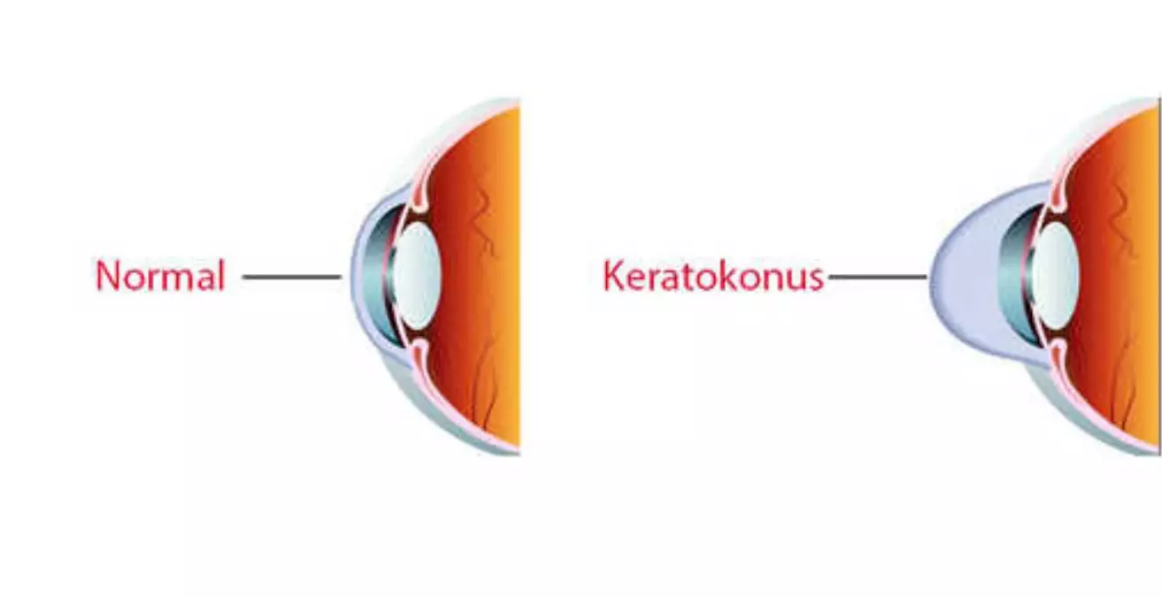 Keratokonus Nasıl Bir Hastalıktır?