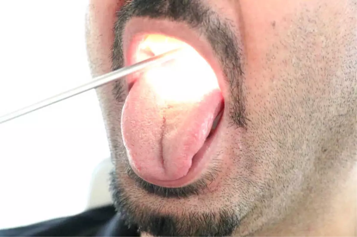 Geçmeyen Ağız Kokusu \'Dil Kanseri\' Belirtisi Olabilir