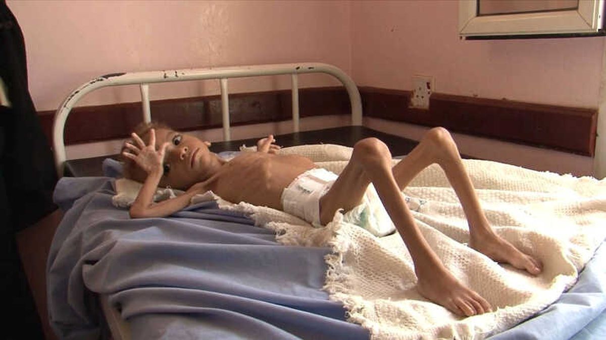 Yemen\'de Savaşın Çocukları Açlıkla Mücadele Ediyor