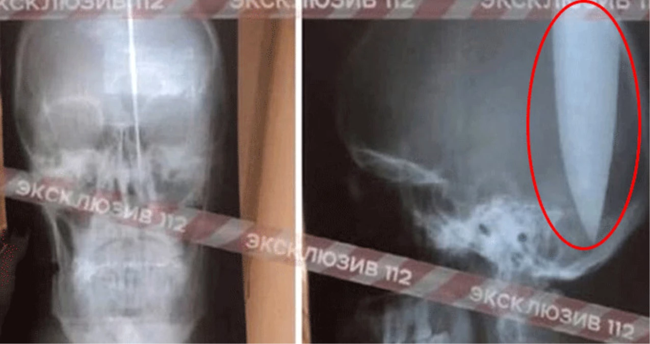 Rusya\'da Burnu Tıkanan Adam, Nefes Almak İçin Bıçakla Başını Deldi