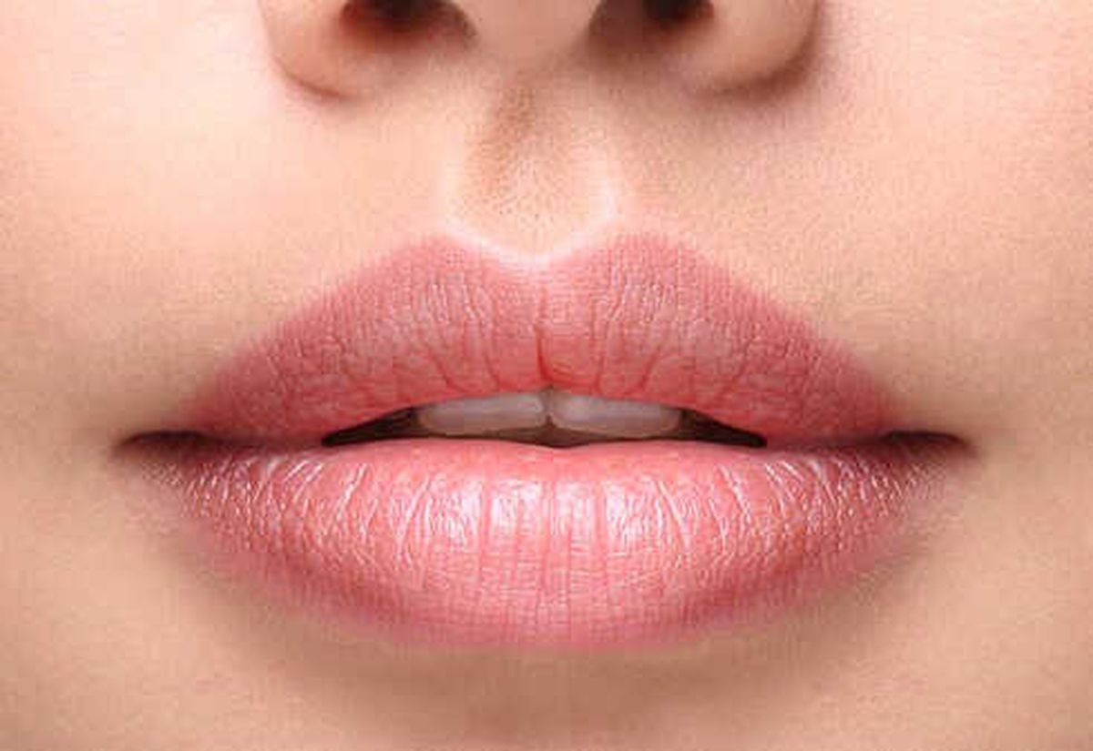 Liplift (Dudak Kaldırma) Nedir?