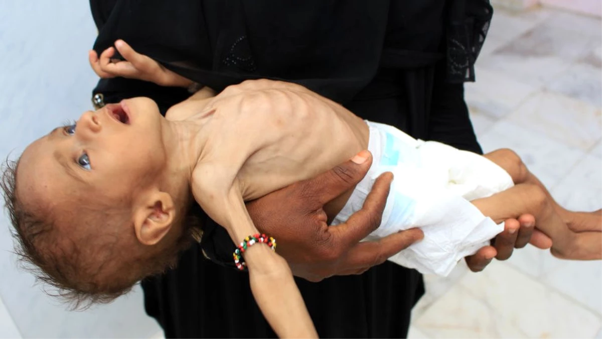 Yemen Krizi: \'85 Bin Çocuk Açlıktan Öldü\'