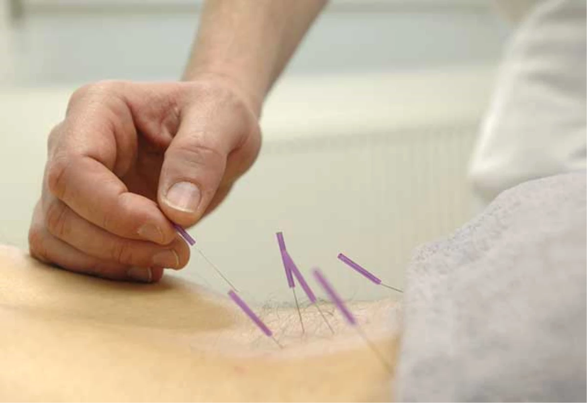 Akupunktur Nedir, Nasıl Yapılır?