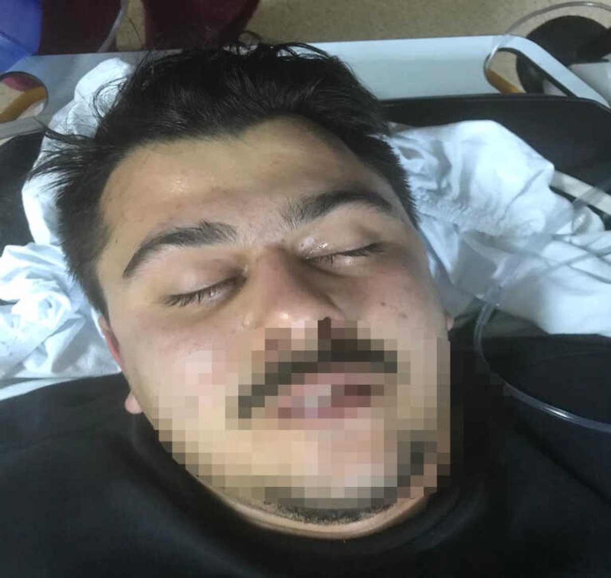 İki Gün Yarı Baygın Gezdi, Kafasından Mermi Çıktı