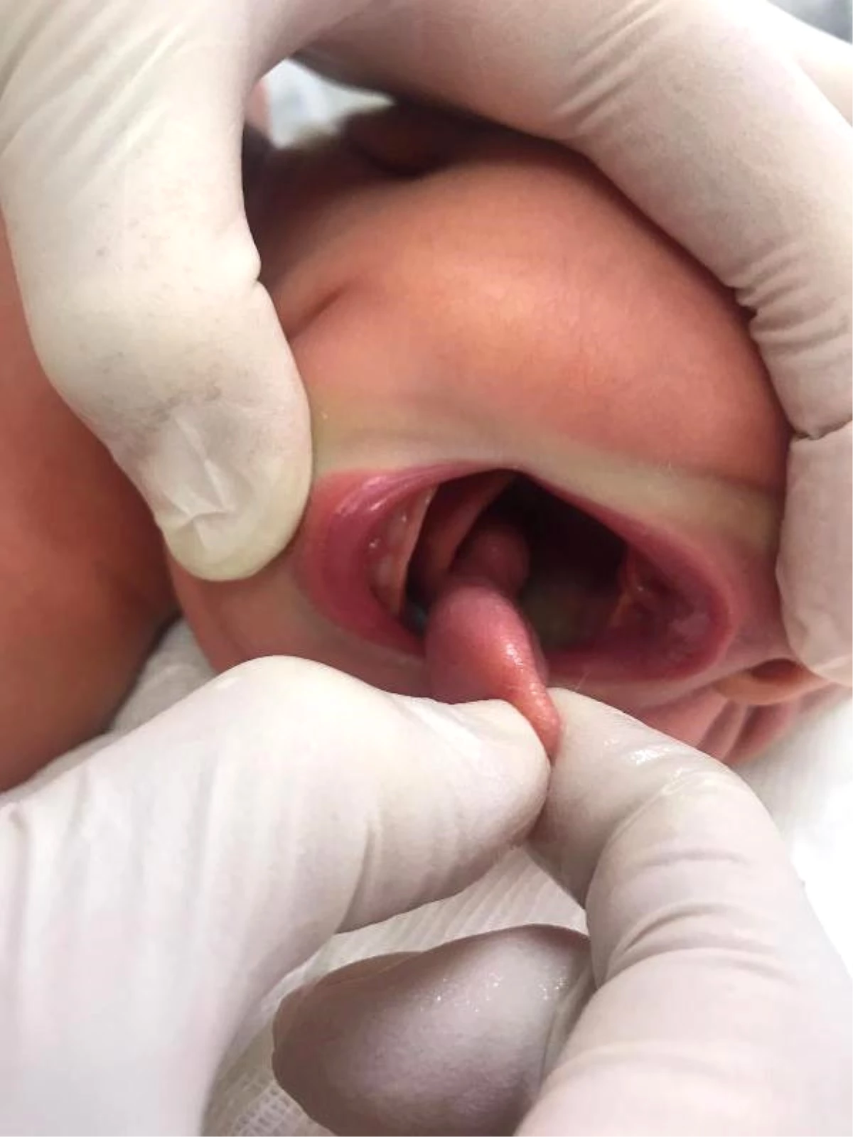 Çift Dilli\' Doğan Zeynep Bebeğin İkinci Dili Ameliyatla Alındı