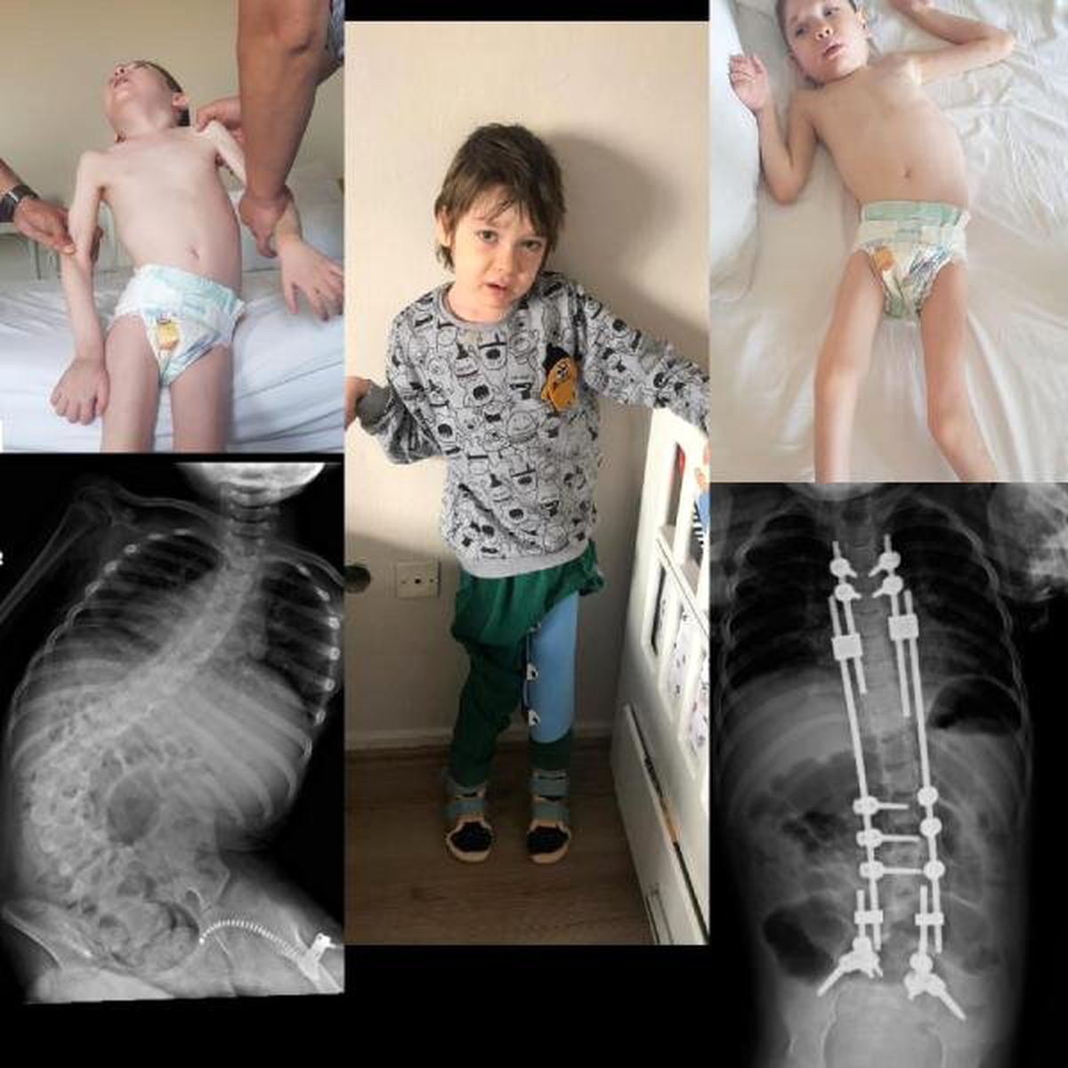 Annesinin Tedavi Masrafları İçin Sarma Sardığı Ayberk, Ayağa Kalktı