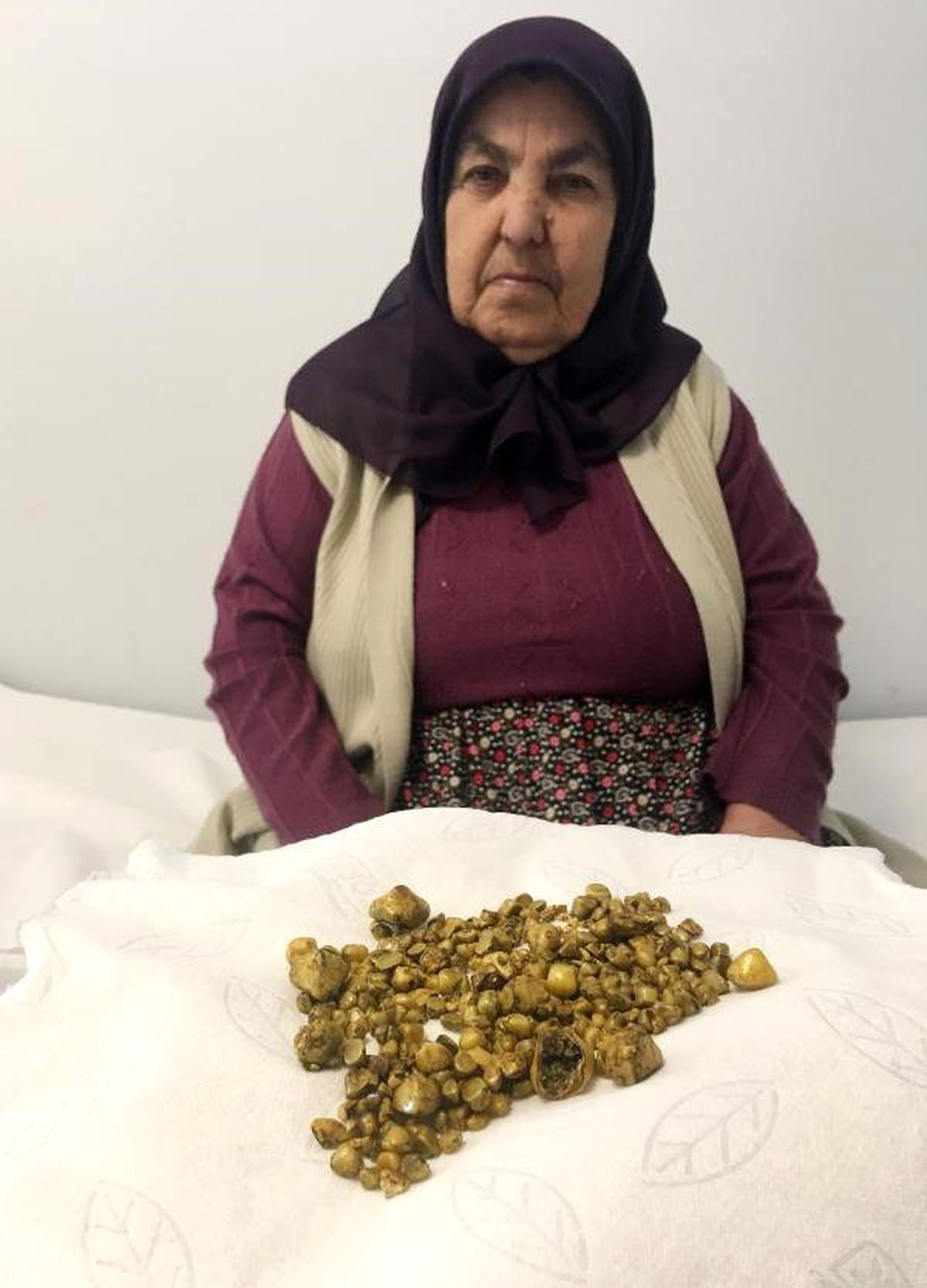 Safra Kesesinden 311 Taş Çıktı