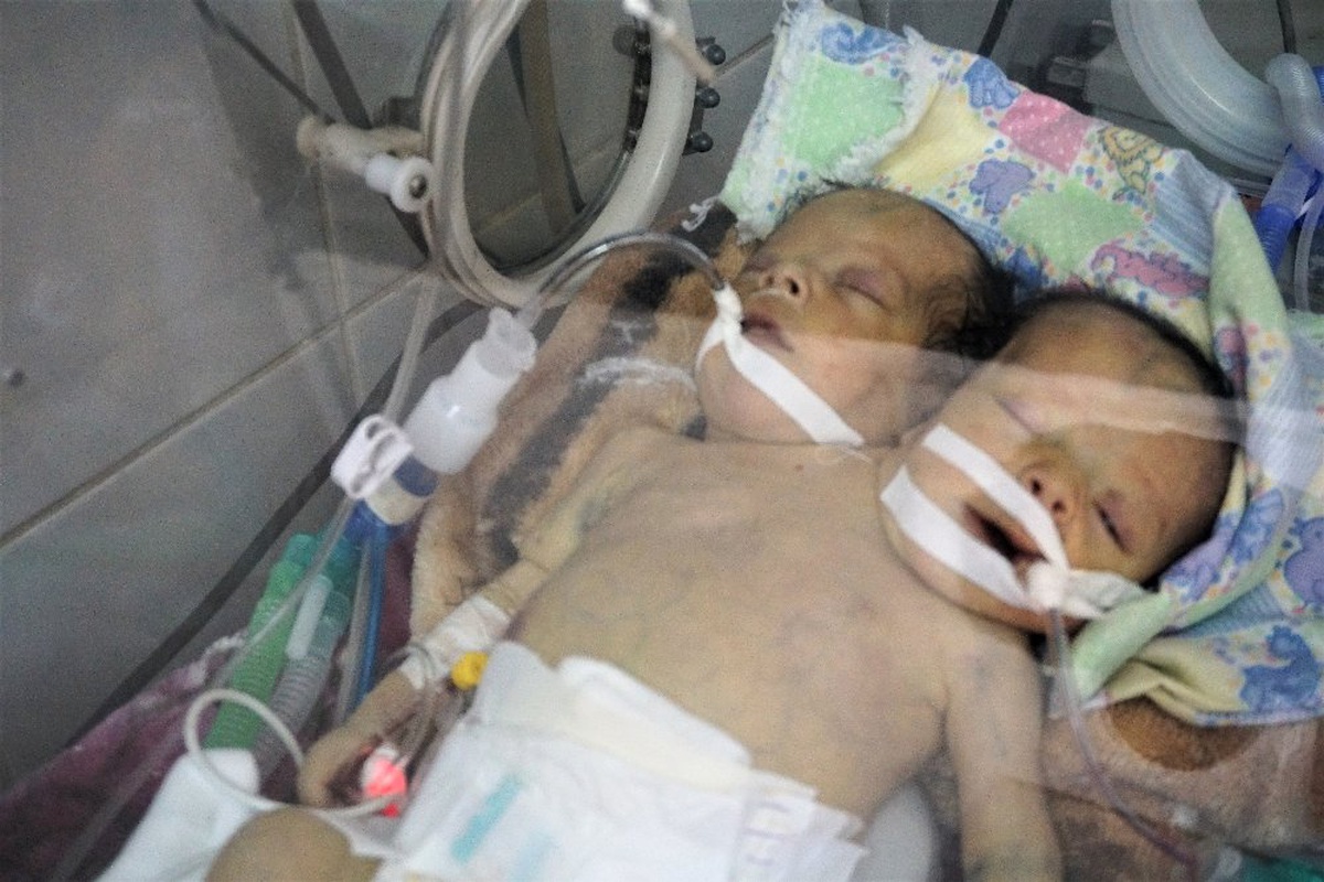 Yemenli Yapışık İkizler Kurtarılamadı