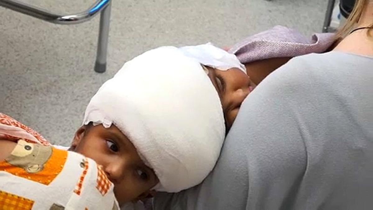 Macar Doktorlar Başı Yapışık İkiz Bebeklerin Ameliyatını Başarıyla Tamamladı