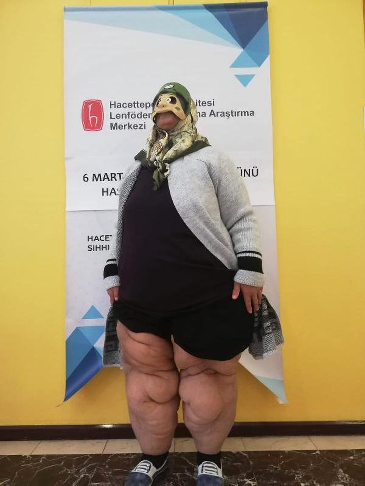 Hacettepe Üniversitesi\'nde \'Lenfödem\' Hastalarına Eğitim