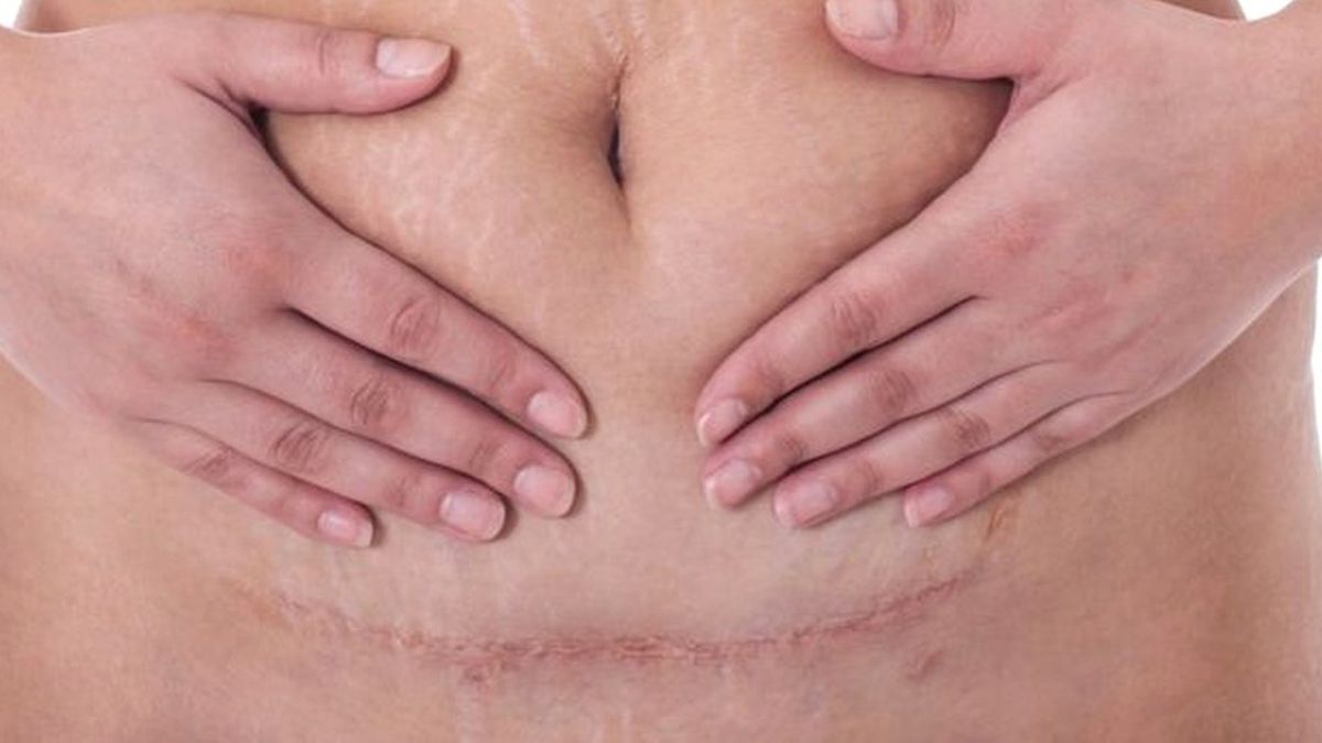 Dünya Genelinde Her Yıl 300 Bin Kadın Sezaryen Doğum Sonucu Ölüyor