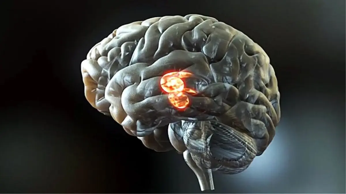 Bilim İnsanları, Beyin Sinyallerini Konuşma Sesine Çeviren Bir İmplant Geliştirdi