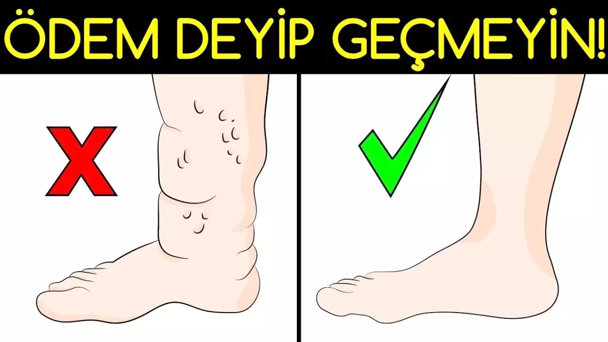 Ayak Şişmesi Deyip Geçmeyin!