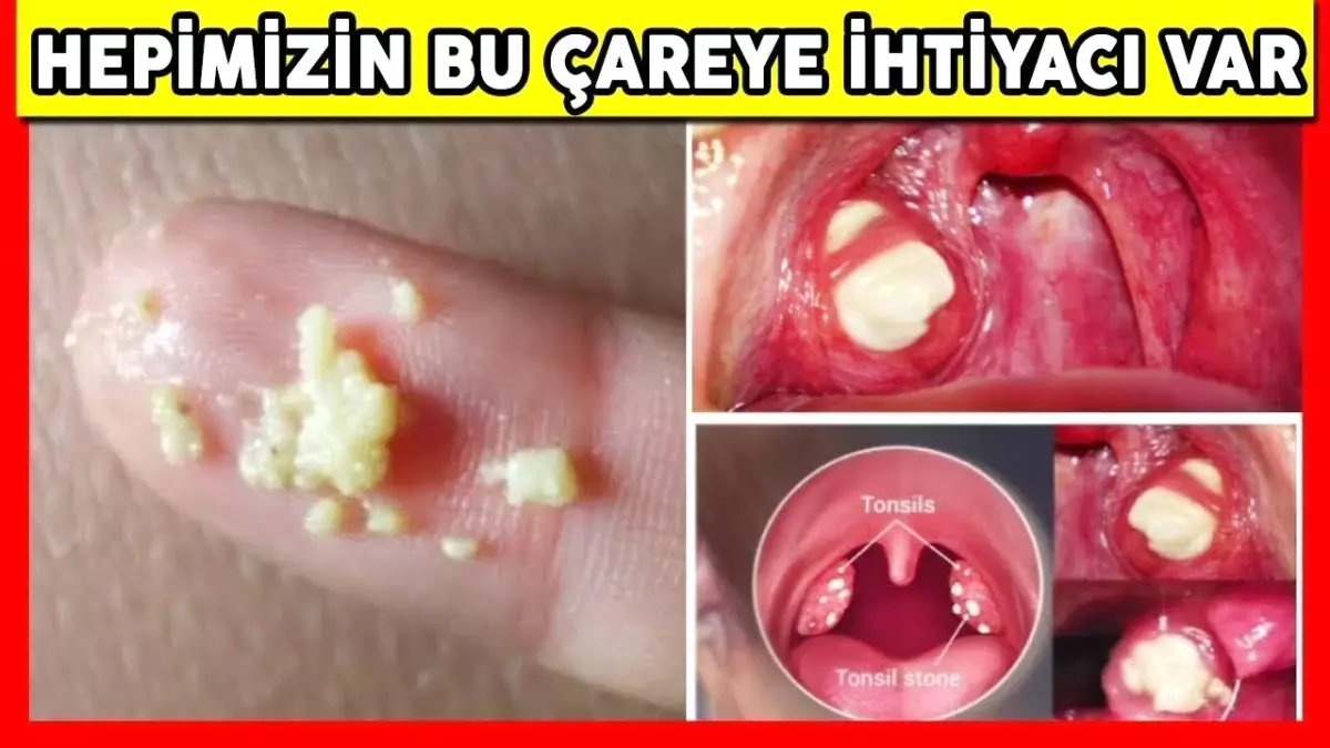 Eğer Ağzınız Kokuyorsa Yapın, Kötü Nefesin Kolay ve Hızlı Bir Şekilde Nasıl Giderileceğini Bilin