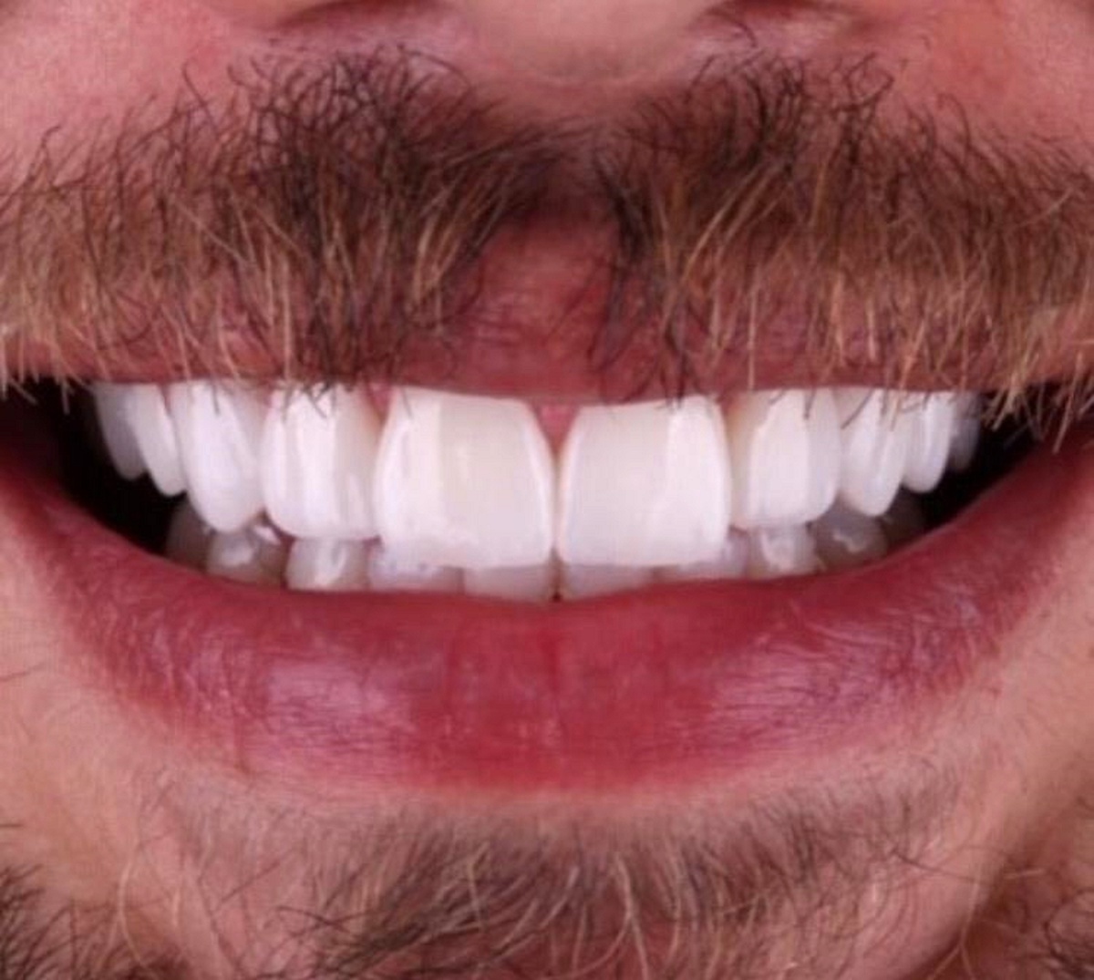 Sağlıkta Dünyanın Gündemi "Dental Detox"