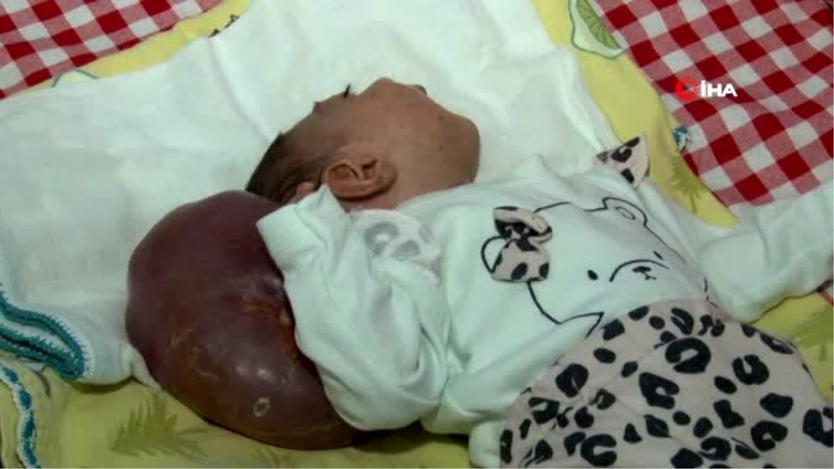 Doktorların "Ölür" dedikleri 2 kafalı doğan bebekleri için çare arıyorlar