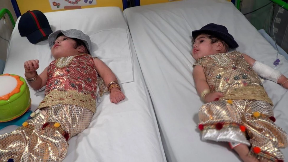 Kafalarından yapışık şekilde doğan iki yaşındaki ikizler, 50 saatlik ameliyatın ardından birbirinden ayrıldı