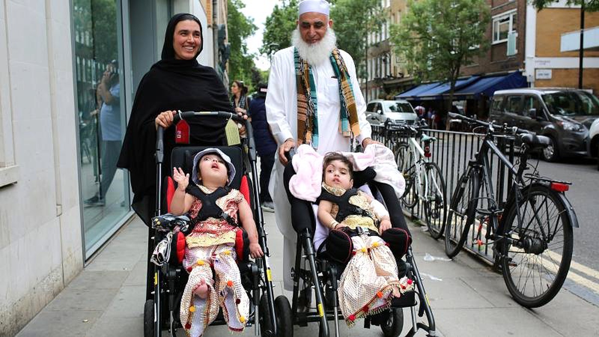 Yapışık ikizler 55 saatlik ameliyatla ayrıldı