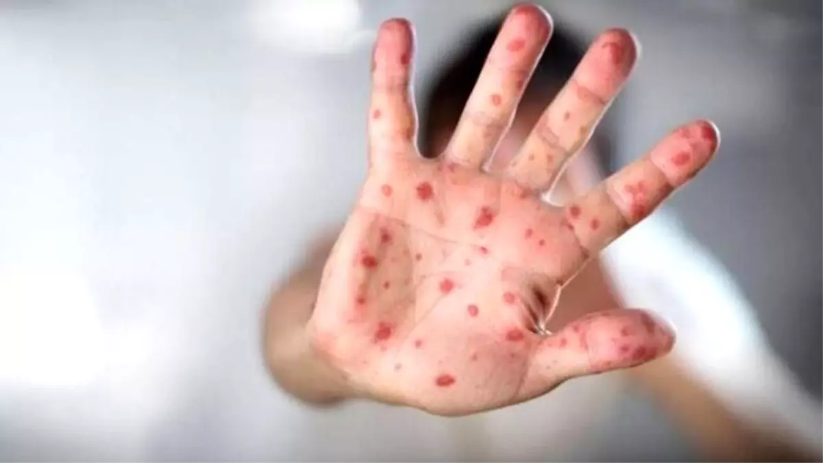 Çocuklarda el, ayak ve ağız hastalığı hastalığına dikkat