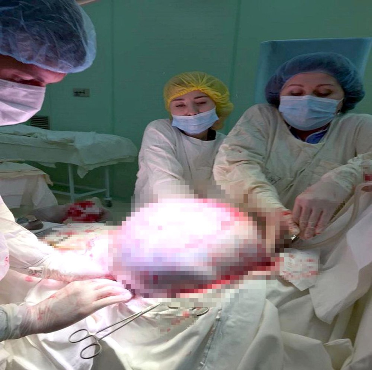 Rusya\'da kadının yumurtalıklarından 25 kilogram tümör çıkarıldı