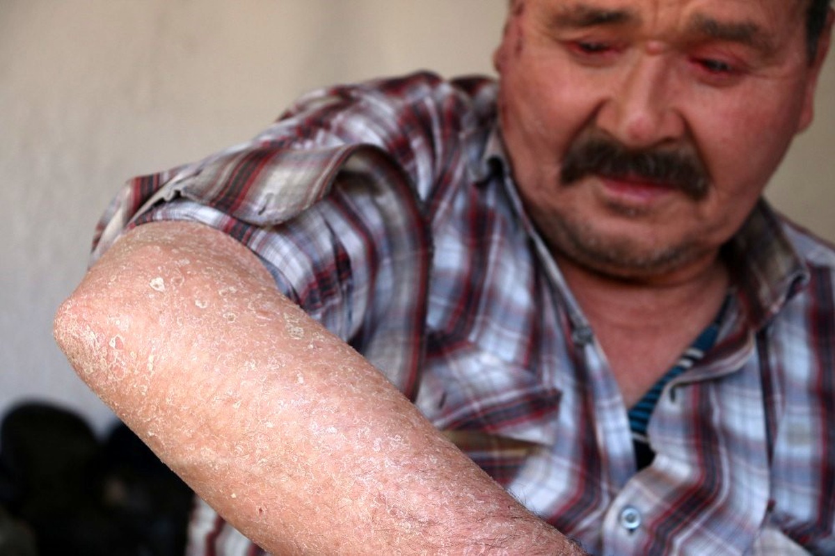 \'Balık pulu\' hastalığı vatandaşların kabusu oldu
