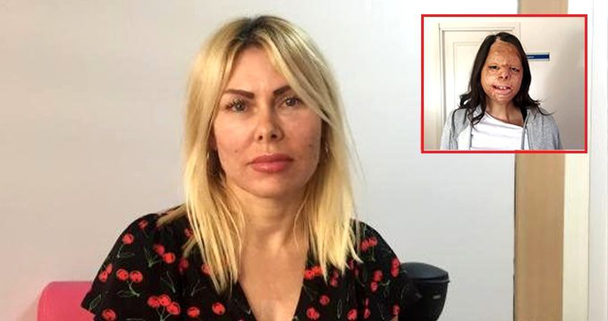 Yangında yanan yüzüne doku nakli yapılan Firdevs, 2 ameliyat daha olacak