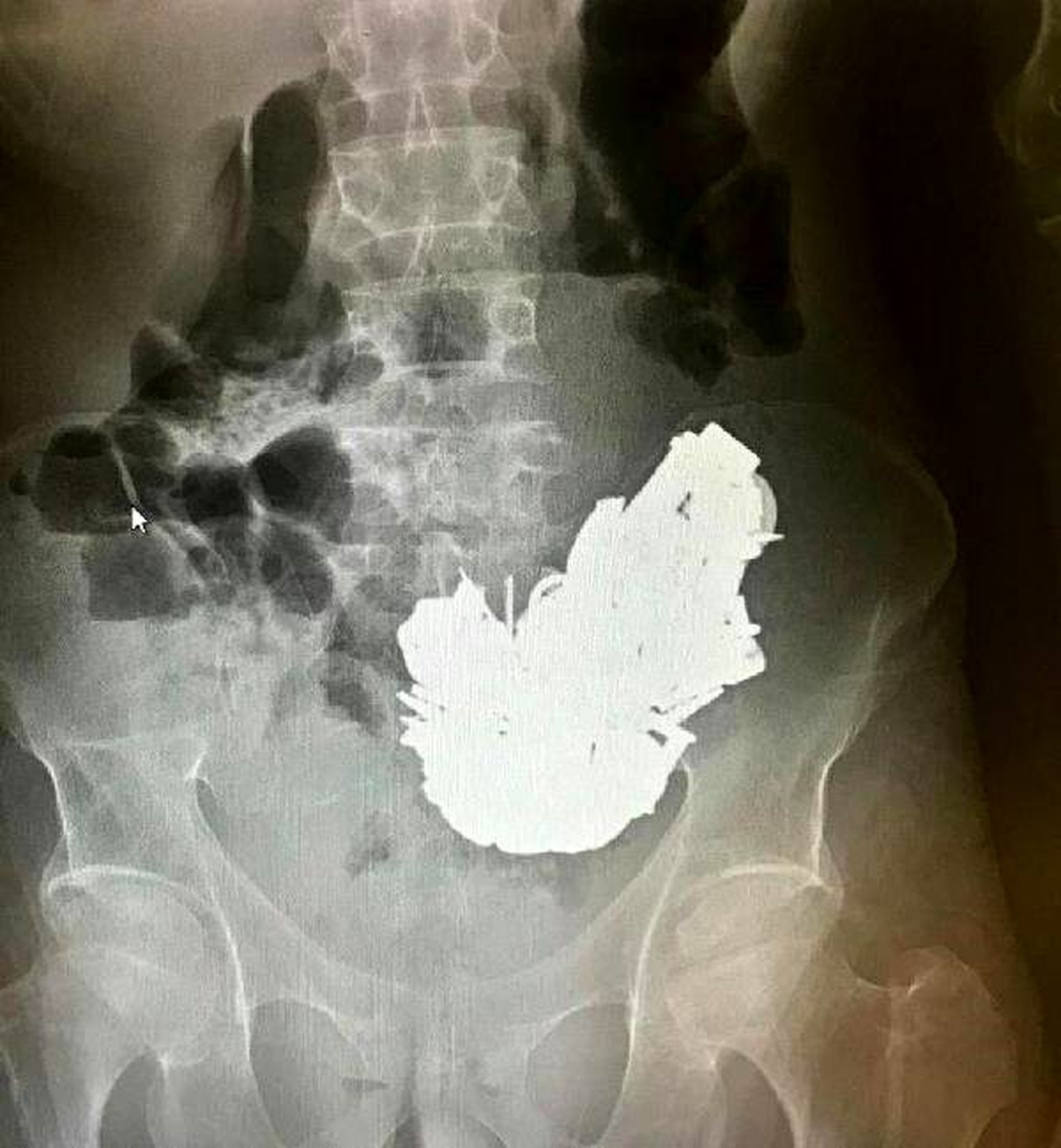 Midesinden 580 gram metal çıkarıldı, zehirlenme sonucu öldü