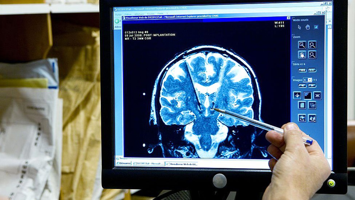 Çin\'de Alzheimer için geliştirilen ilaca onay çıktı