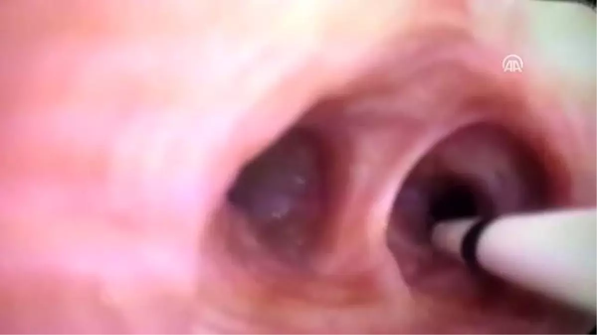 (TEKRAR) "Bronşiyal termoplasti" ile 15 yıl mücadale ettiği astımdan kurtuldu