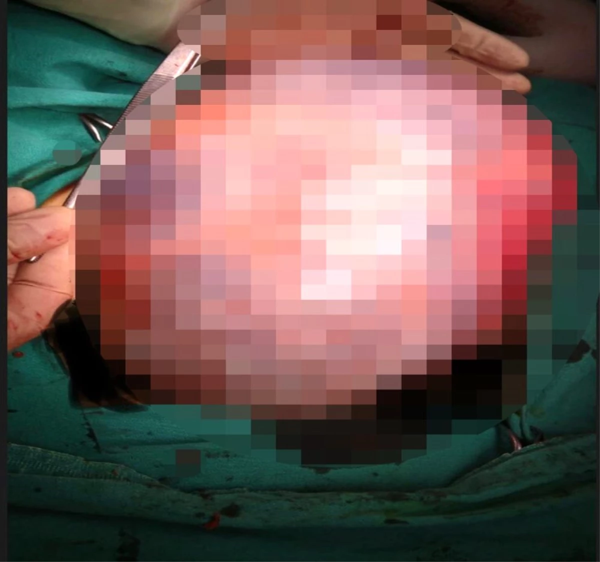 Tam 30 santimetre: Genç kadının karnından operasyonla alındı
