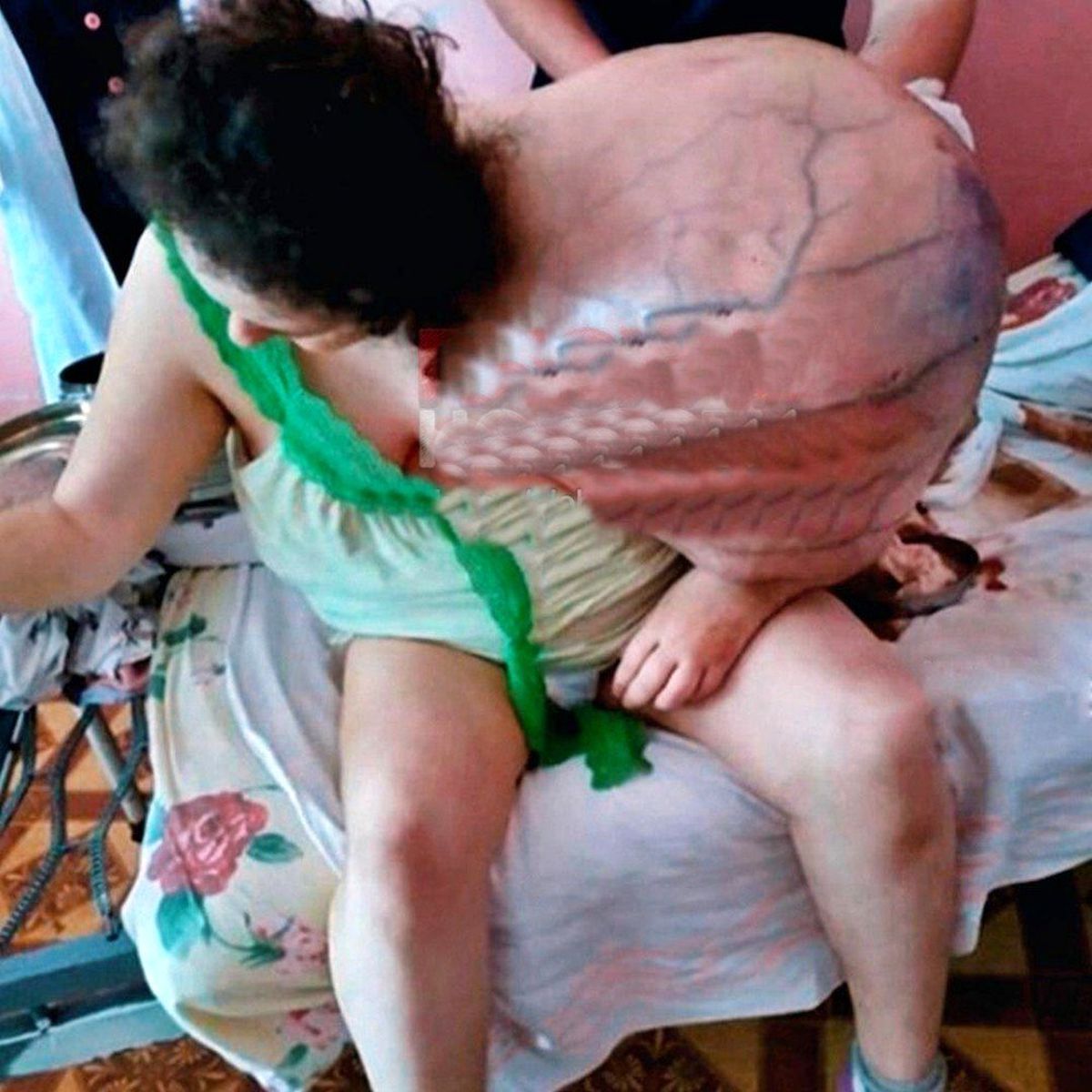 Hasta kadın omzundaki devasa tümörü taşıyamaz hale geldi