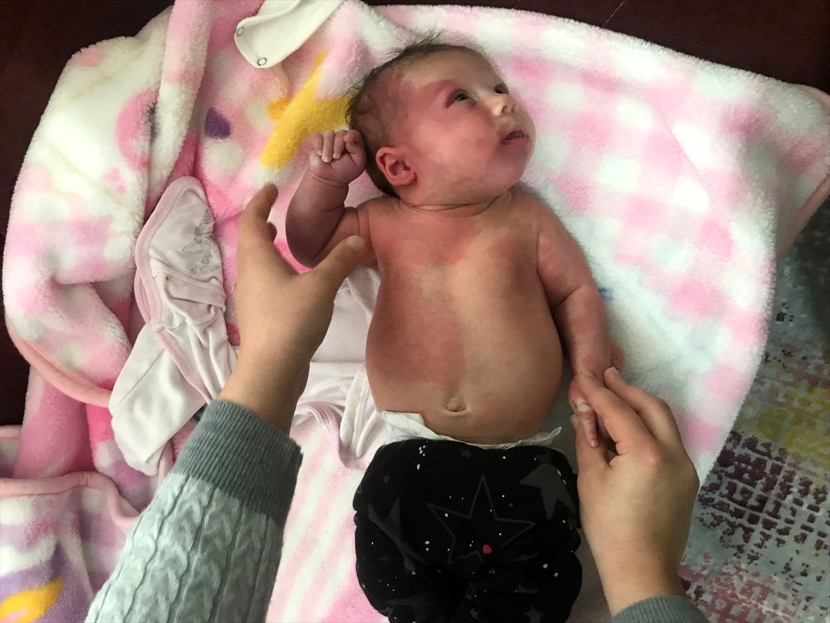 Sturge Weber sendromlu Hira bebeğin ailesi yardım bekliyor