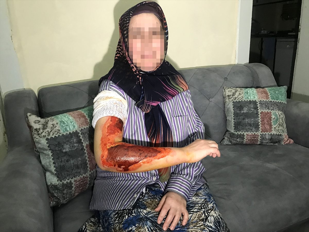 Karabük\'te eşinin koluna sıcak su döktüğü iddia edilen kocaya uzaklaştırma cezası