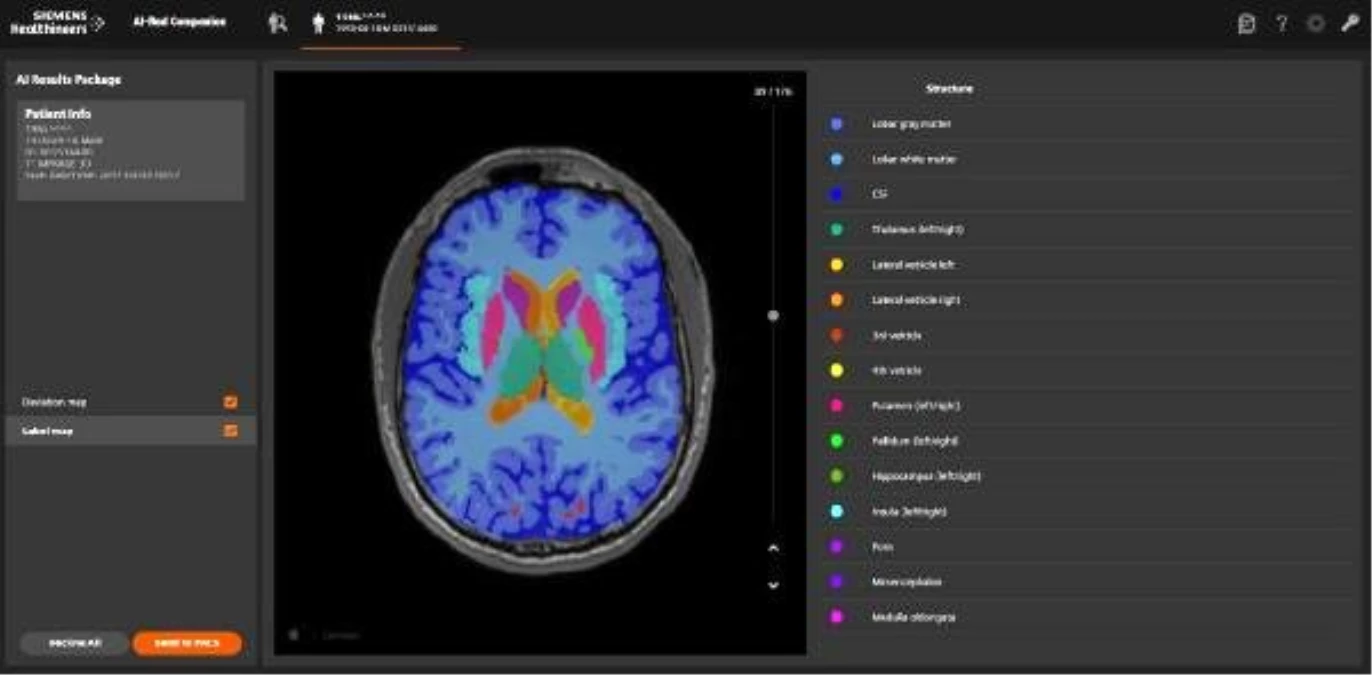 "Yapay zeka MR ile birleşince hastalık teşhisleri kolaylaştı"