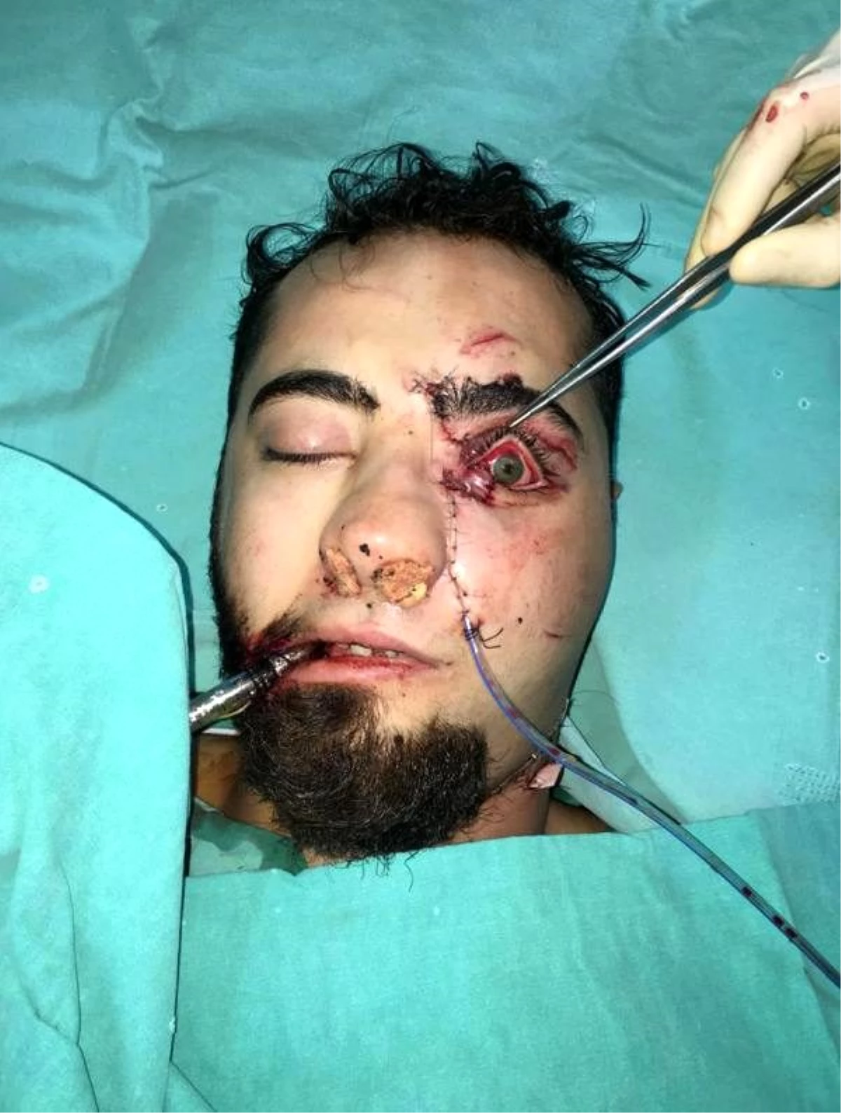 Yüzüne demir saplanan genci, itfaiye ve plastik cerrahlar kurtardı