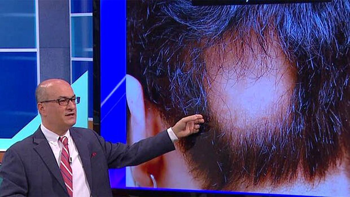 Saç kıran nasıl tedavi edilir?