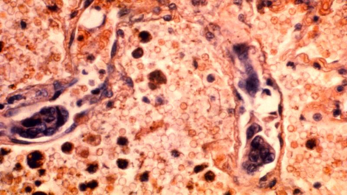 Bilim adamları bazı tümörlerin içinde kanserle savaşan hücreler buldu