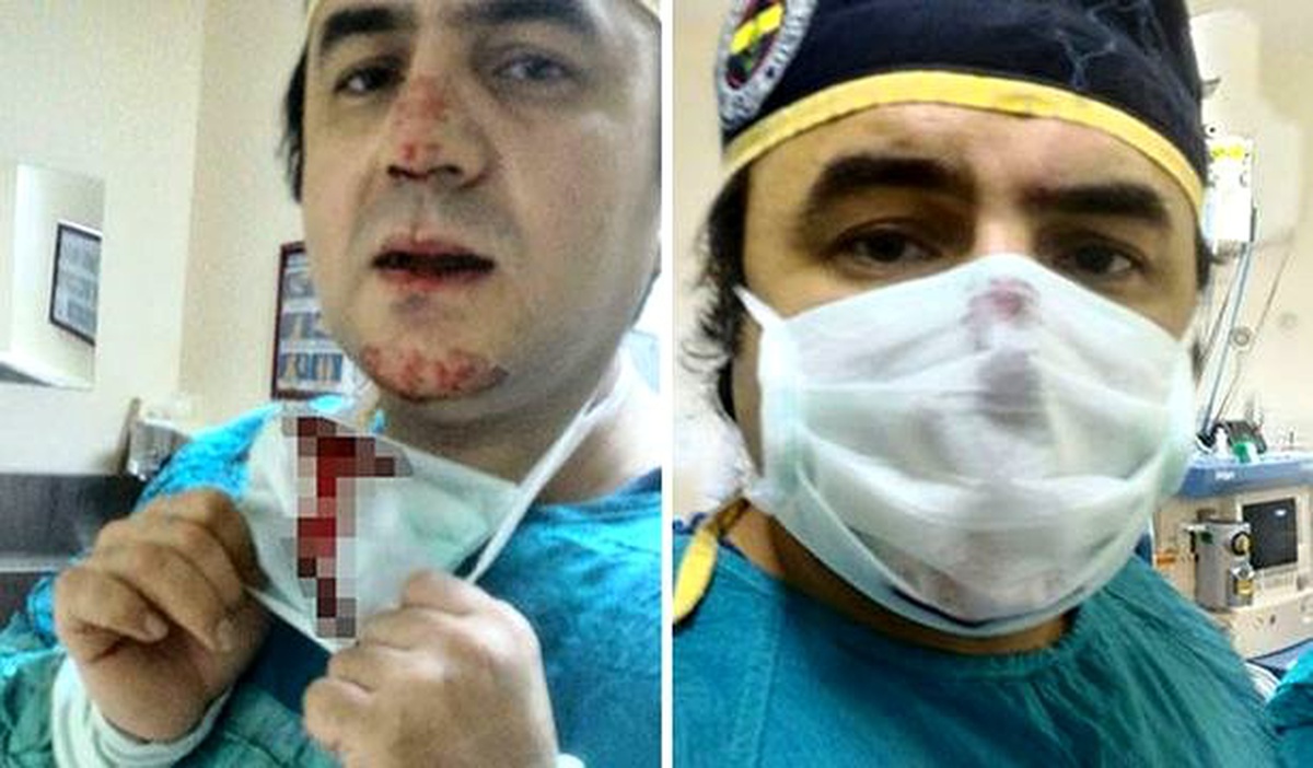 Doğum Yapacak Kadının Kocası Tarafından Burnu Kırılan Doktor Kırık Burunla Doğumu Gerçekleştirdi