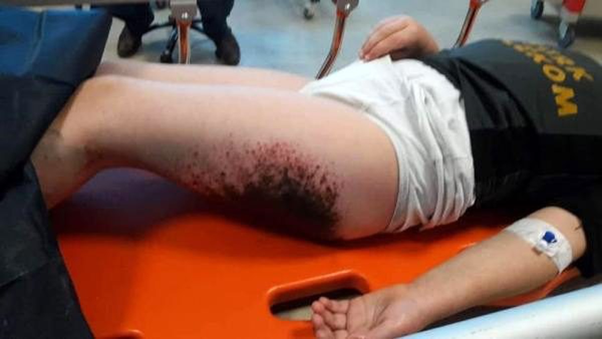 Karla oynarken vücutlarında yanık oluşan 2 çocuğa doku nakli yapılacak