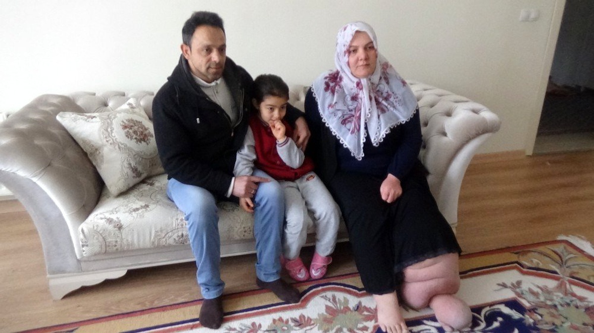 Fil hastalığına yakalanan Ayşe yardım bekliyor