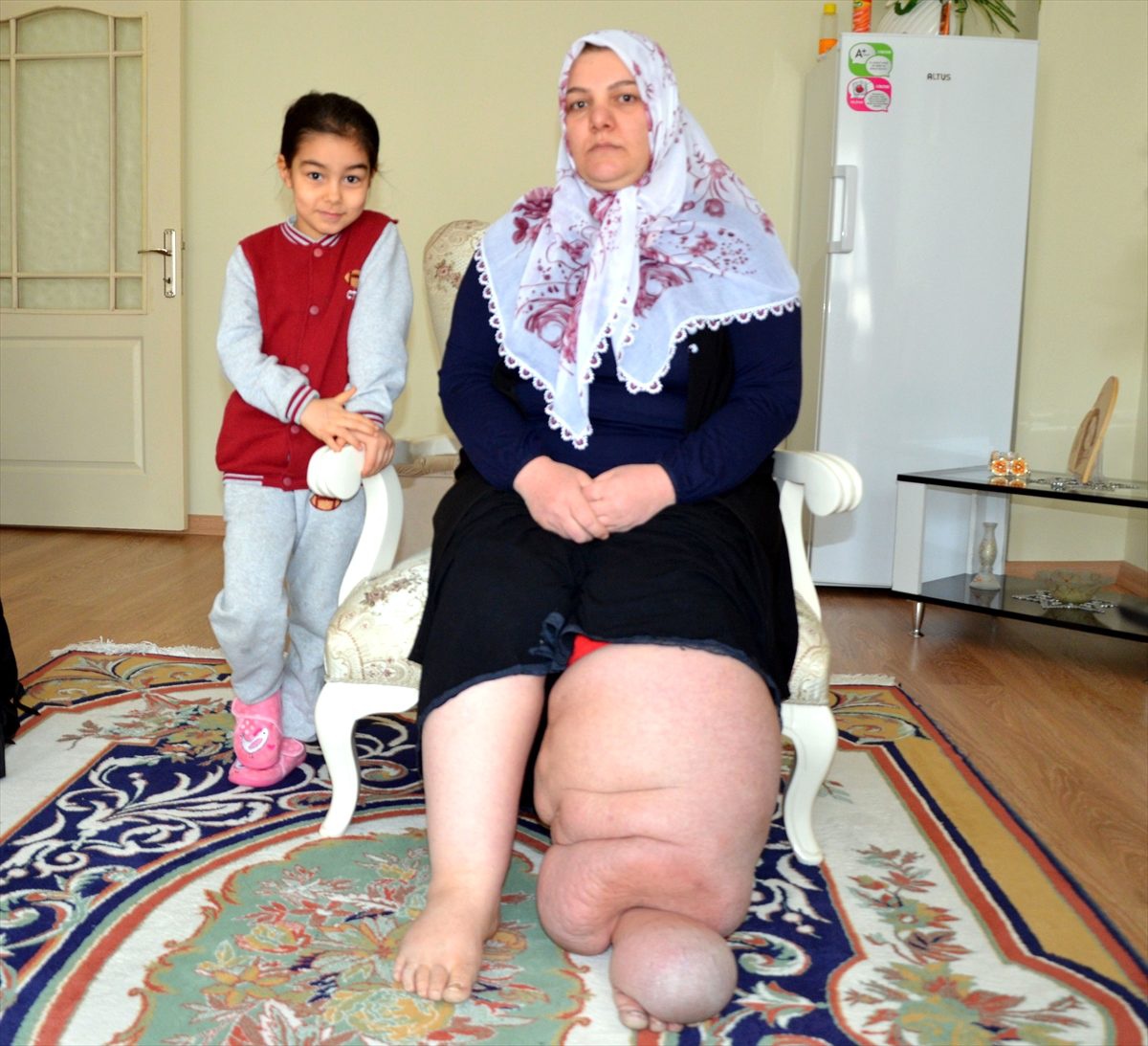 Fil hastası kadın tedavi için yardım bekliyor