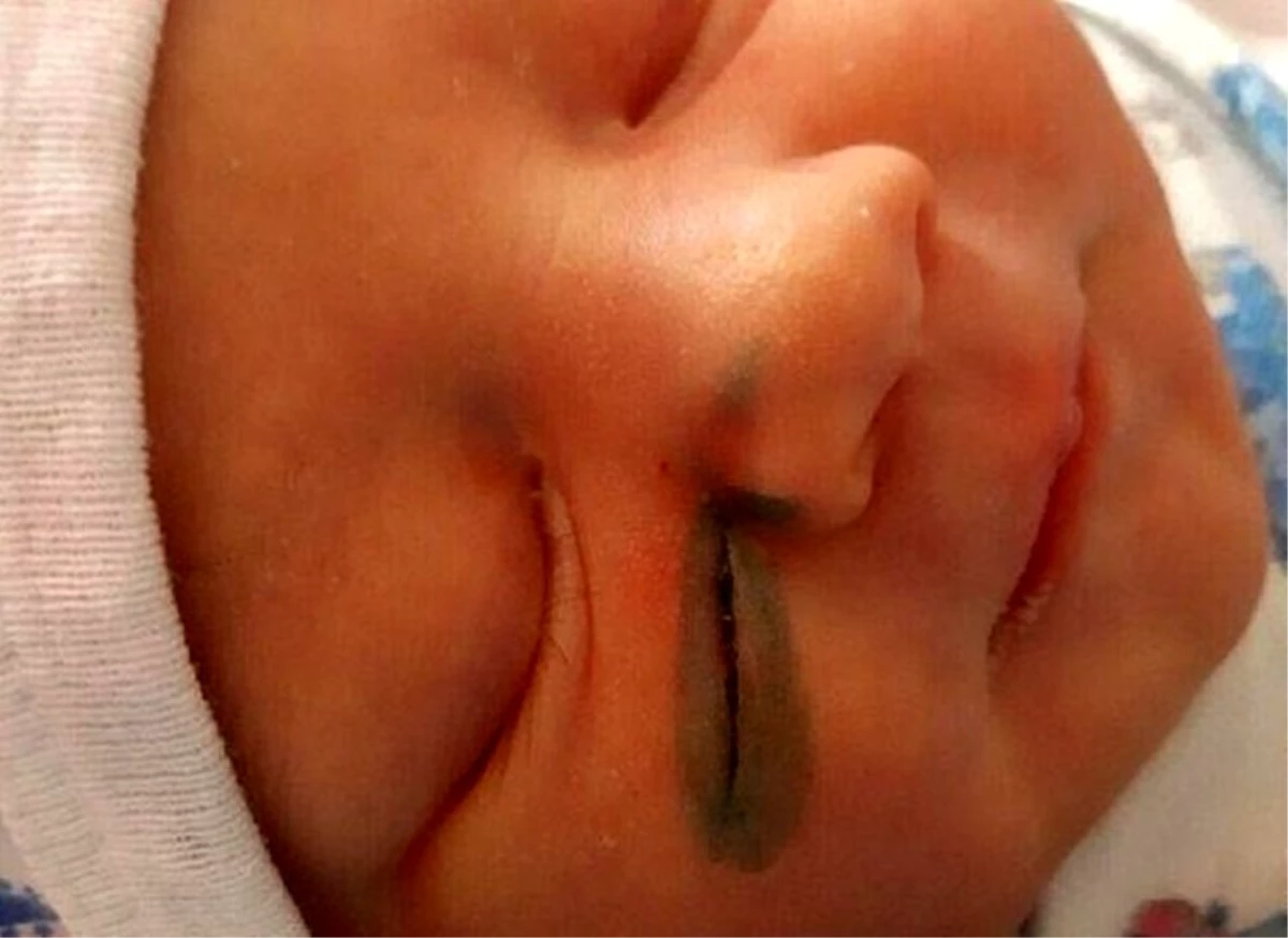 Rusya\'da doktorlar doğum sırasında bebeğin yüzünü kesti