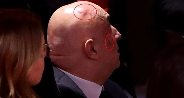 Meclis'teki yumruklu kavga sonrası CHP'li Engin Özkoç'un kafasında ve yüzünde şişlik oluştu